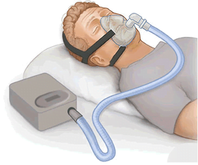 عوارض CPAP